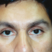 After photo of male botox patient at Rejuv Laser Spa in Temecula.