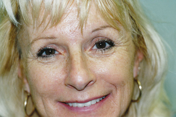 Text: Before photo of female botox patient at Rejuv Laser Spa in Temecula.