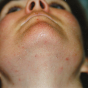 Chin after laser hair removal treatment in Temecula, CA.